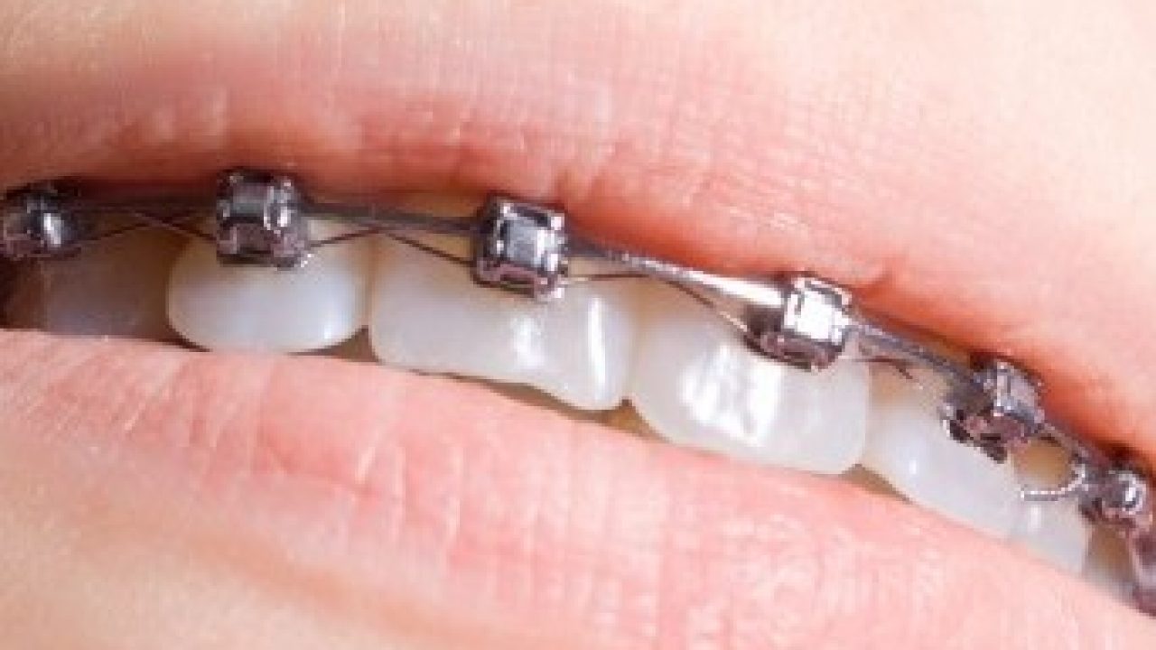 Incredible Thigh Odorless Aparat dentar metalic | 10 motive pentru care sa îl alegi